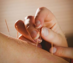 Acupuncture at Alchemy Clinic, Frontenac, MO